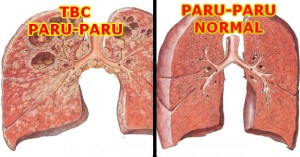 Kenali Tanda-Tanda Anda Terserang TBC!