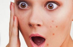 Jerawat pada Orang Dewasa