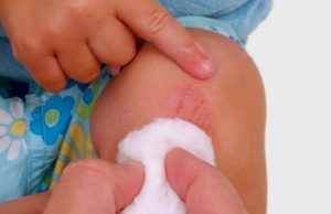 Cara Alami Hilangkan Bekas Luka Secara Alami