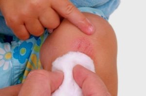 Cara Alami Hilangkan Bekas Luka Secara Alami
