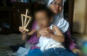 Balita di Margahayu 4 Tahun Bertahan Hidup Tanpa Anus